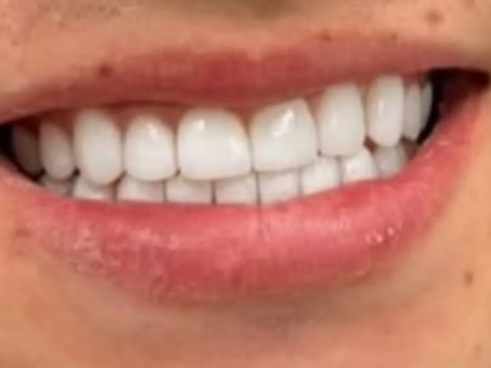 La sonrisa después del tratamiento, con la arcada completa.