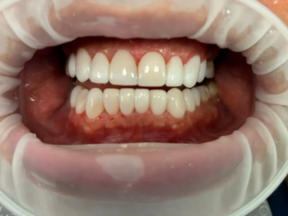 Vista retraída después: dientes parejos y claros.