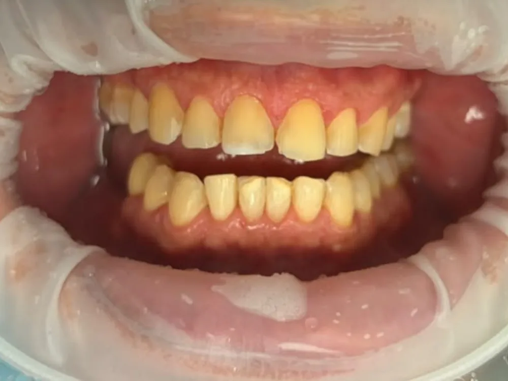 Vista retraída antes: dientes de tono oscuro.