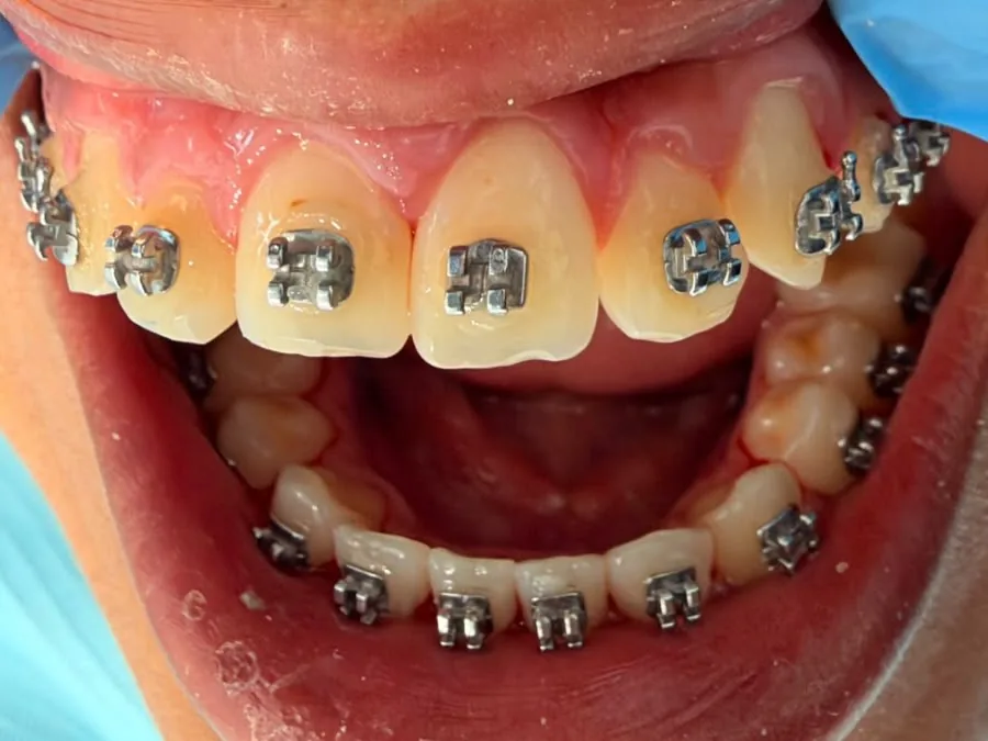 Brackets colocados en los dientes superiores e inferiores.