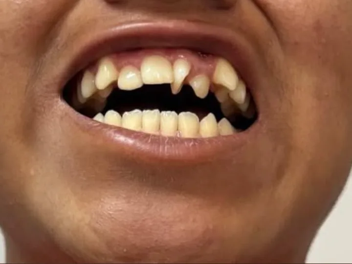 Dientes superiores apiñados antes de la ortodoncia.